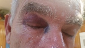 2015 11 08 Eye Steve attack by light